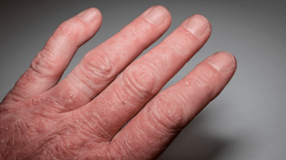 Ψωριασική αρθρίτιδα στα χέρια